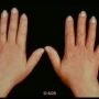 تورم دستها در فاز ادماتو بیماری اسکلرودرمی